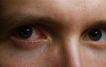Почему краснеют глаза утром после сна и как с этим бороться?